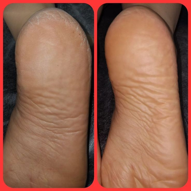 ترک پاشنه پا