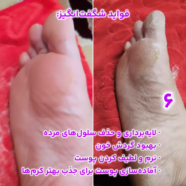 پینه و ترک کف پا